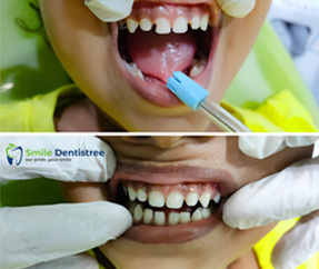 Light Cure Restoration