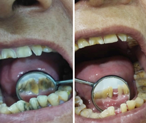 Teeth Cleaning