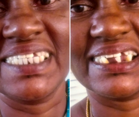 Removable Partial Denture