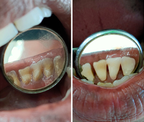Teeth Cleaning