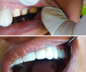 Root Canal Treatment