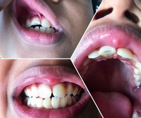 Pulpectomy for Pedo & Zirconia Crown Placed