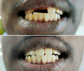 Post and Core Buid up, Crown and Bridges