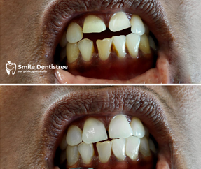 Composite Restoration